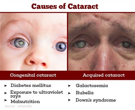 What Causes Cataract In Newborns