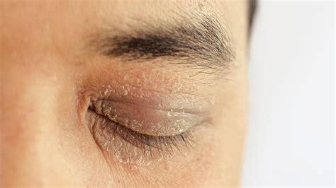 What Causes Dry Crusty Eyes